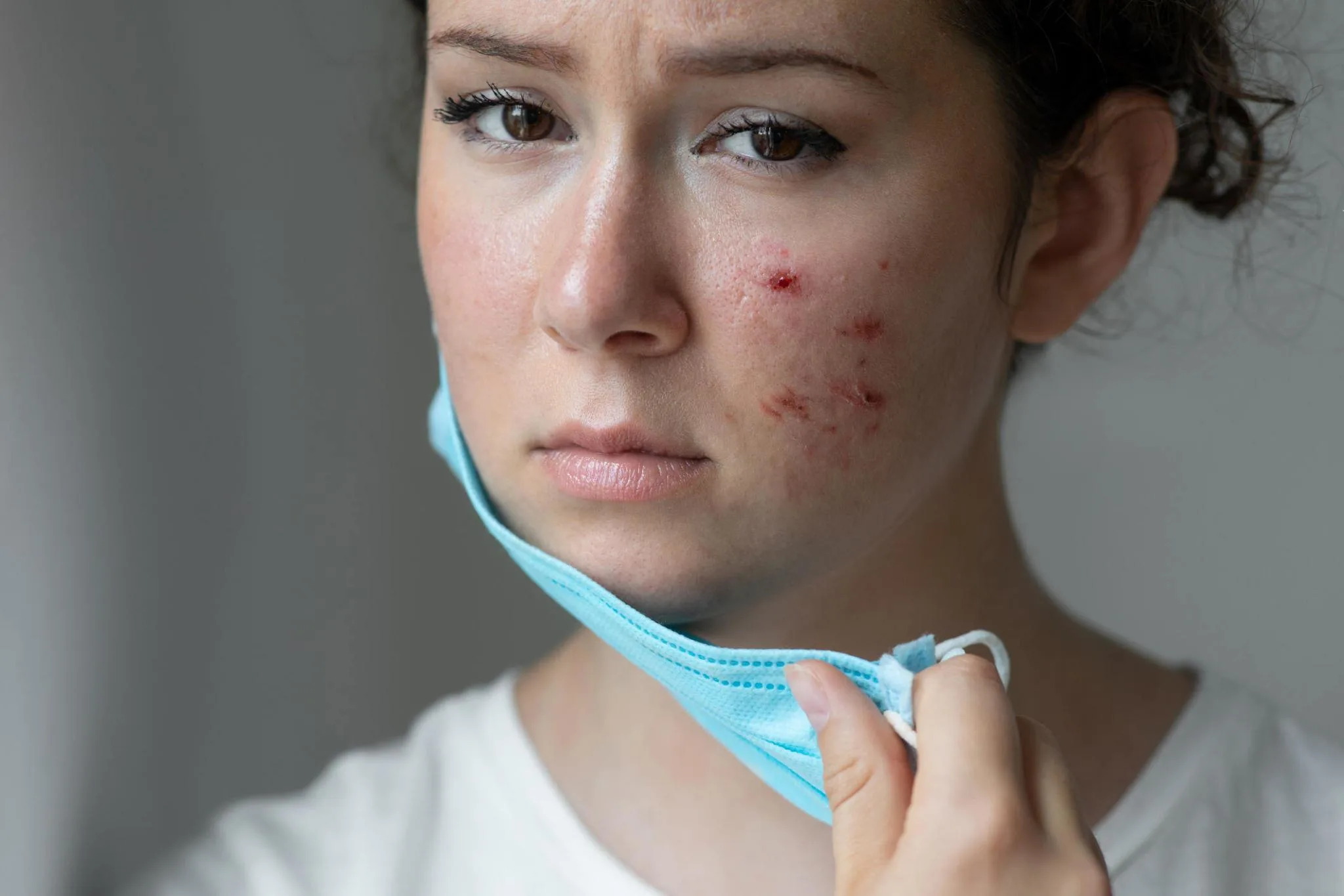 Transforming Your Skin: Tretinoin's Acne Scar Journey Transforming Your Skin: Tretinoin's Acne Scar Journey